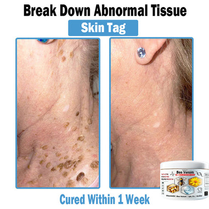 TODAHOF™ Bee Venom Multi-Symptom Skin Treatment Cream (👨‍⚕NPF RECOMMENDS)